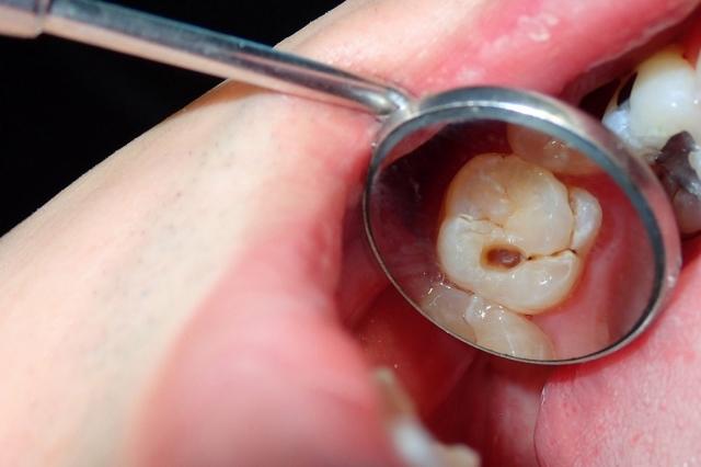 How Much Should a Posterior Root Canal Cost?