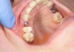 Can an Implant Infection Spread to Other Teeth?