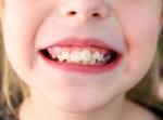 What Are the Risks of Untreated Crowded Teeth?
