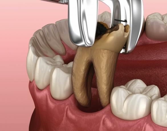 Gentle and Efficient Tooth Extractions by Dubai’s Experts