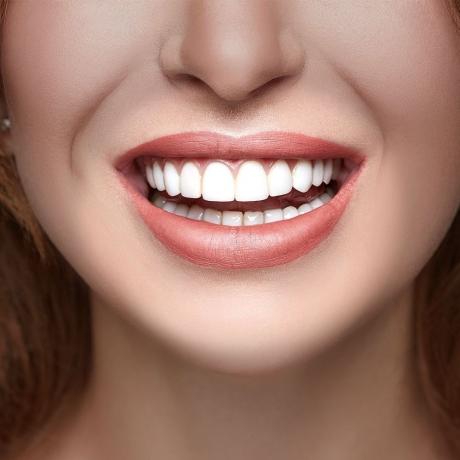 E-max Veneers in Dubai The Future of Smile Design