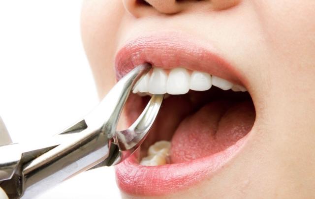 A Comprehensive Guide to Wisdom Tooth Extraction