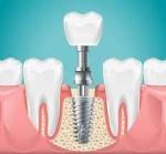 Fast-Track Your Smile with Same-Day Dental Implants