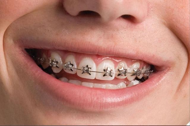 How Dental Braces Can Improve Your Oral Health