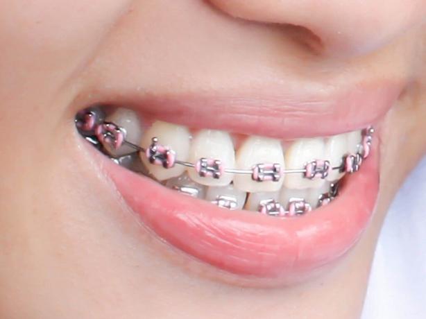 Braces, A Step Toward Better Dental Health