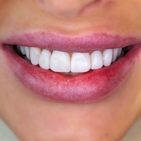 Will Composite Bonding Look Natural?